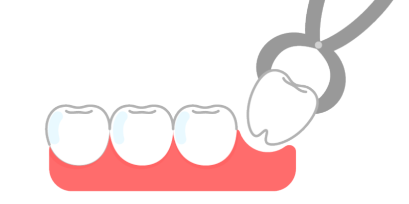 インビザラインは最小限の抜歯で済む -福岡矯正歯科相談室