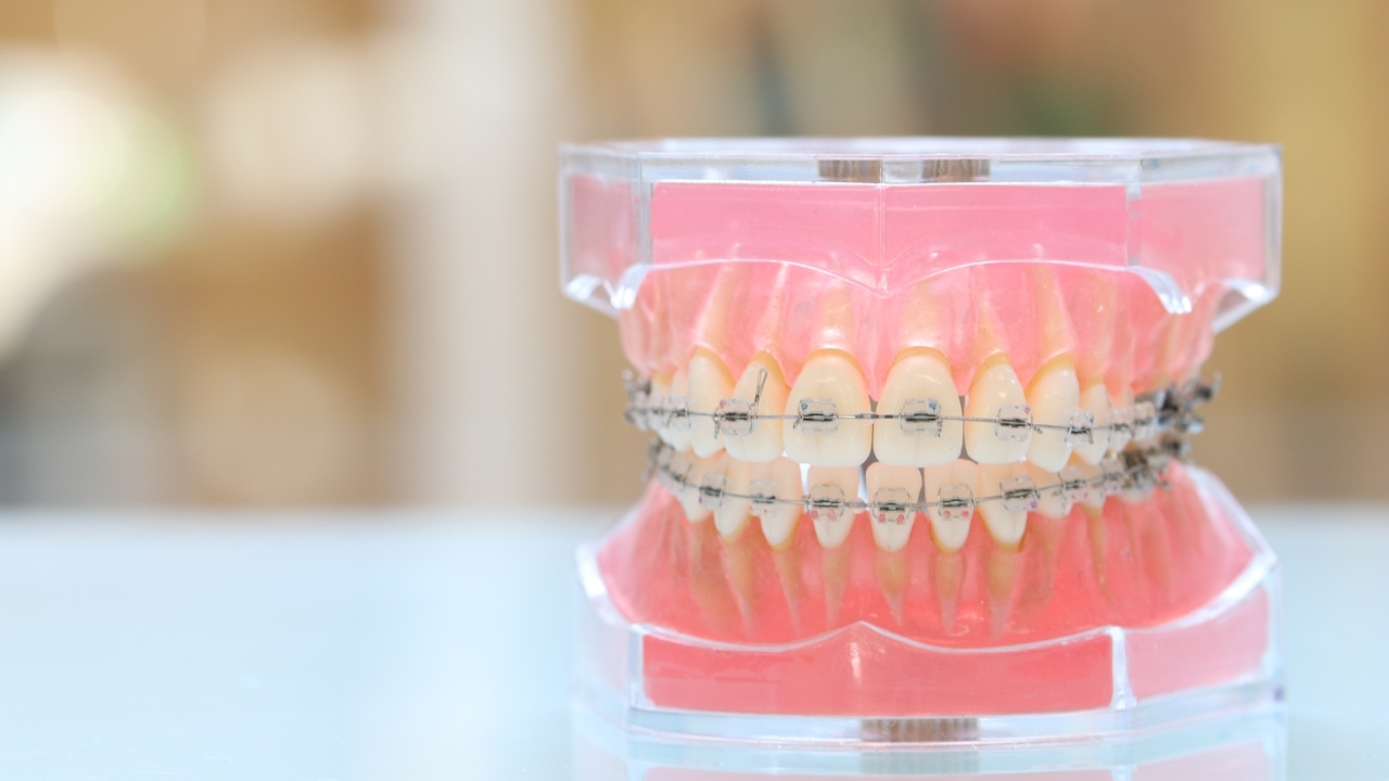 ワイヤー矯正に関する案内ページへのリンク