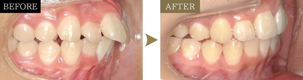 出っ歯の矯正治療前後の比較写真