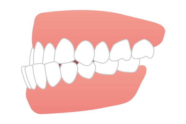 下あごが上あごより前に出る受け口・しゃくれ（反対咬合・下顎前突）のイラスト