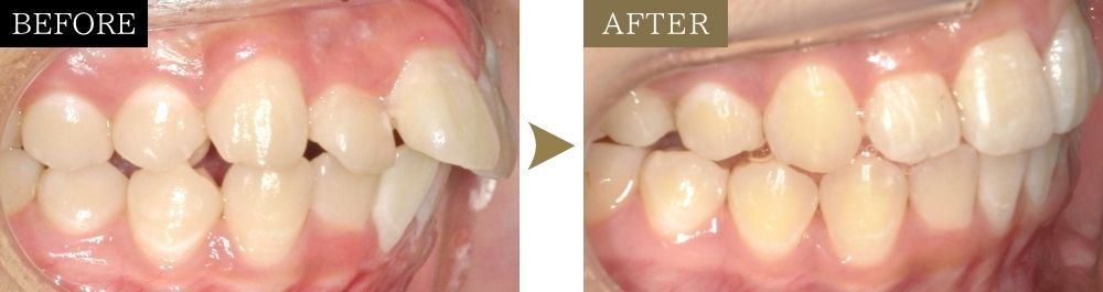 出っ歯を改善した症例のビフォーアフター