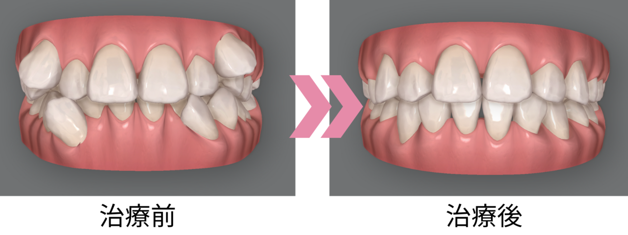 治療前と治療後を比較した歯並びのシミュレーション画像