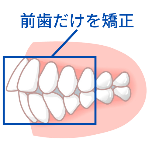 前歯だけを動かす矯正で失敗 - 福岡矯正歯科相談室