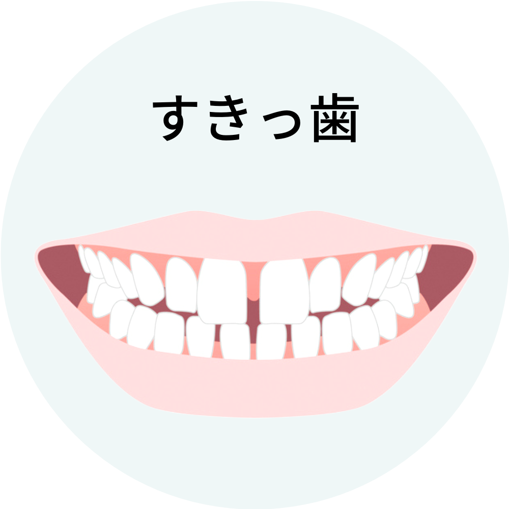 福岡県福岡市博多のすきっ歯の矯正治療