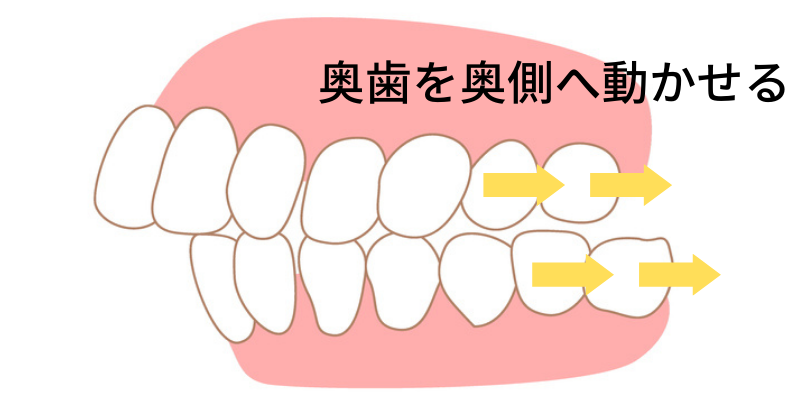インビザラインは奥歯を動かせる - 福岡矯正歯科相談室