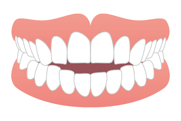 奥歯で噛んでも前歯が噛み合わない開咬（オープンバイト）のイラスト