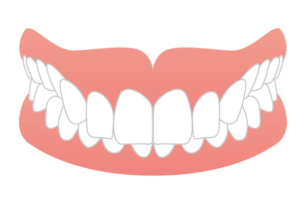 上の前歯が下の前歯を覆いすぎる過蓋咬合（ディープバイト）のイラスト