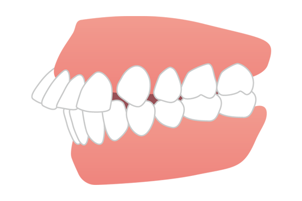 上の前歯が外側に飛び出ている出っ歯（上顎前突）のイラスト