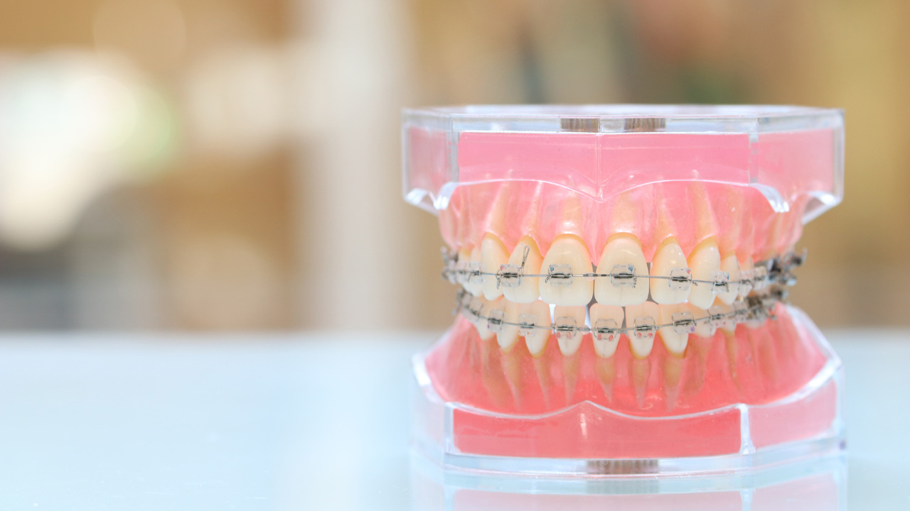 ワイヤーとブラケットを着けている歯の模型