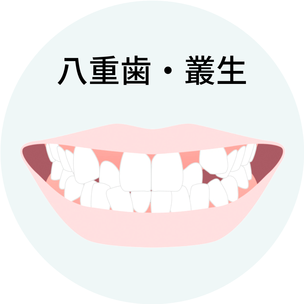 福岡県福岡市博多の八重歯・叢生の矯正治療