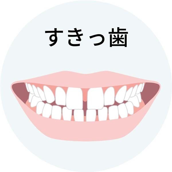すきっ歯