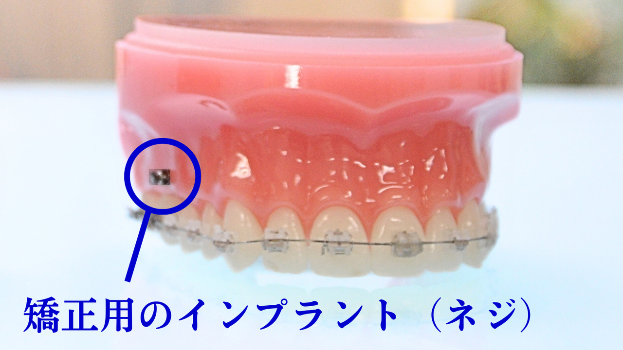 アンカースクリューが埋め込まれた歯の模型