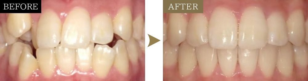 八重歯・ガタガタの治療前後比較写真