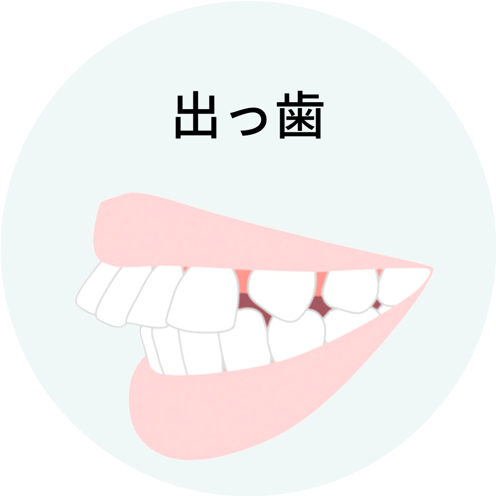 福岡県福岡市博多の出っ歯・上顎前突の矯正治療