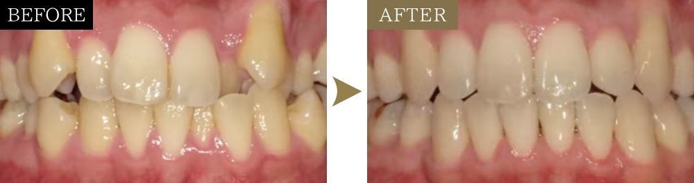 口ゴボと八重歯の矯正治療前後の比較写真