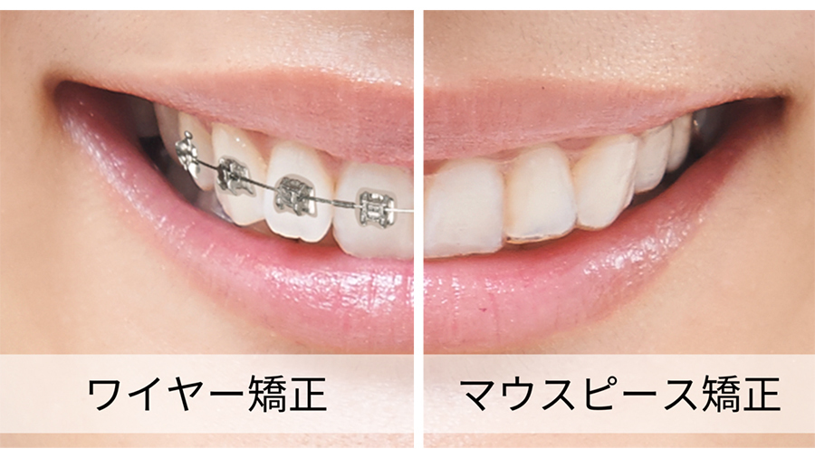 マウスピース矯正かワイヤー矯正か