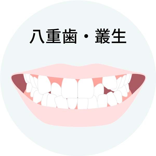 八重歯・叢生