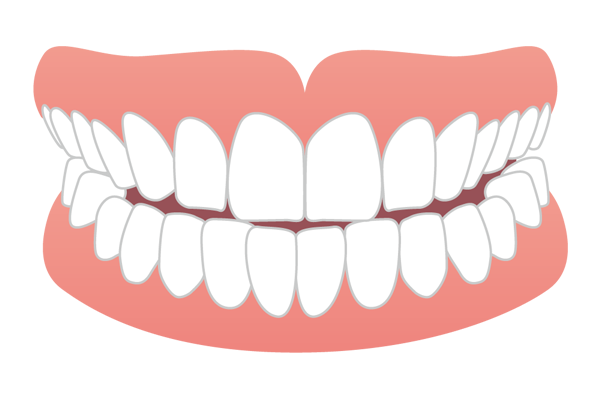 上下の前歯の先端が当たる切端咬合のイラスト